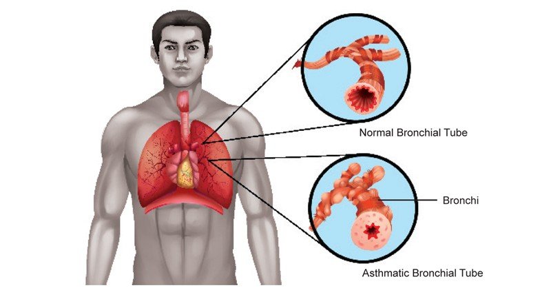 Asthma-in-Respiratory-System