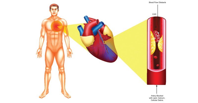 Coronary-Artery-Disease-and-Heart-Attack
