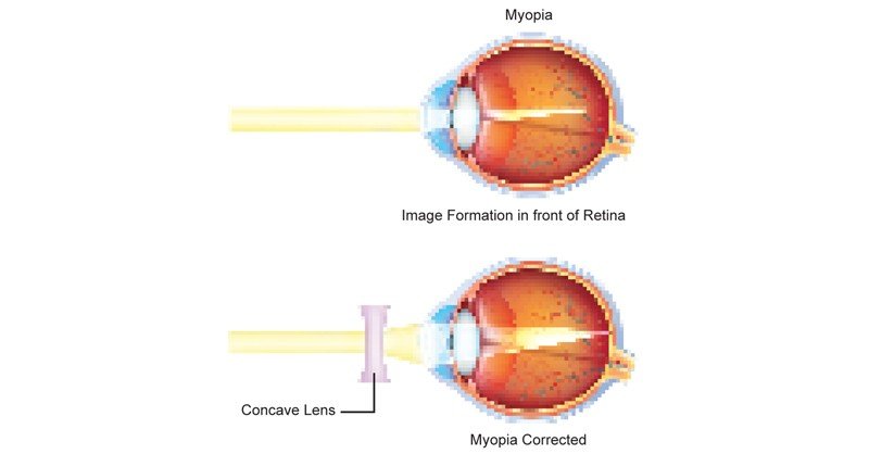 Myopia